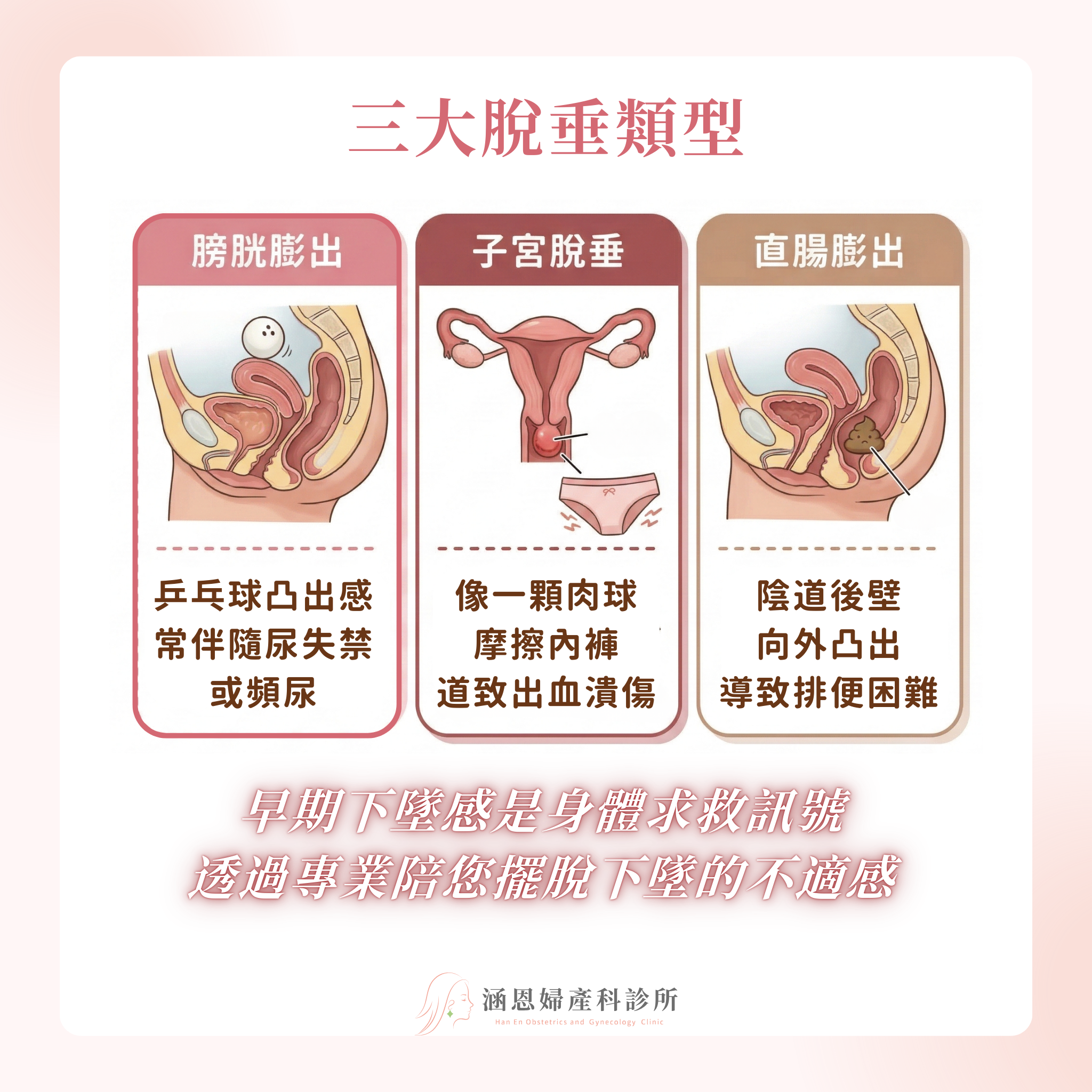 骨盆底功能障礙與骨盆器官脫垂POP膀胱膨出子宮脫垂直腸膨出病理機制