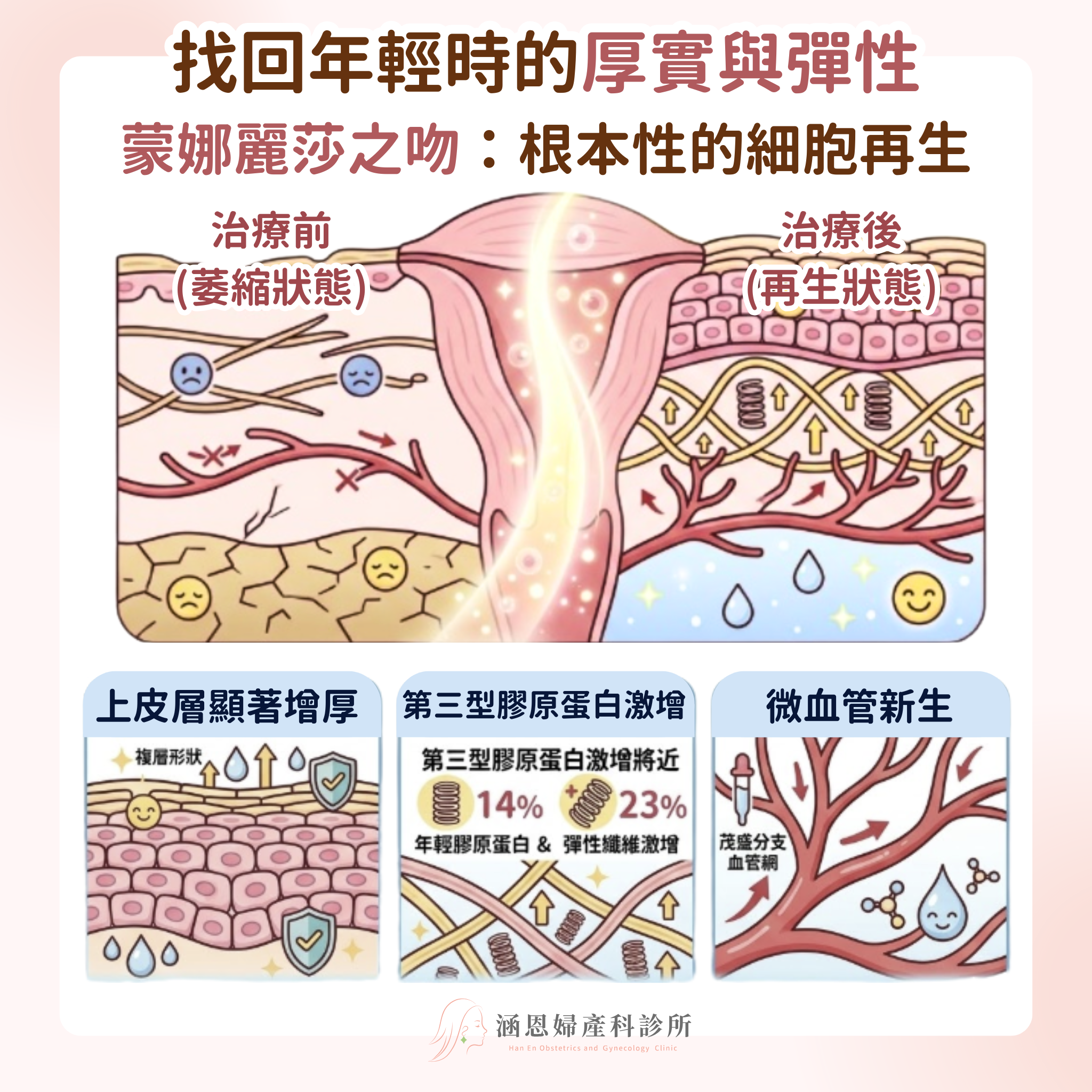 蒙娜麗莎之吻醫學實證組織學改變：上皮增厚、第三型膠原蛋白激增與微血管新生